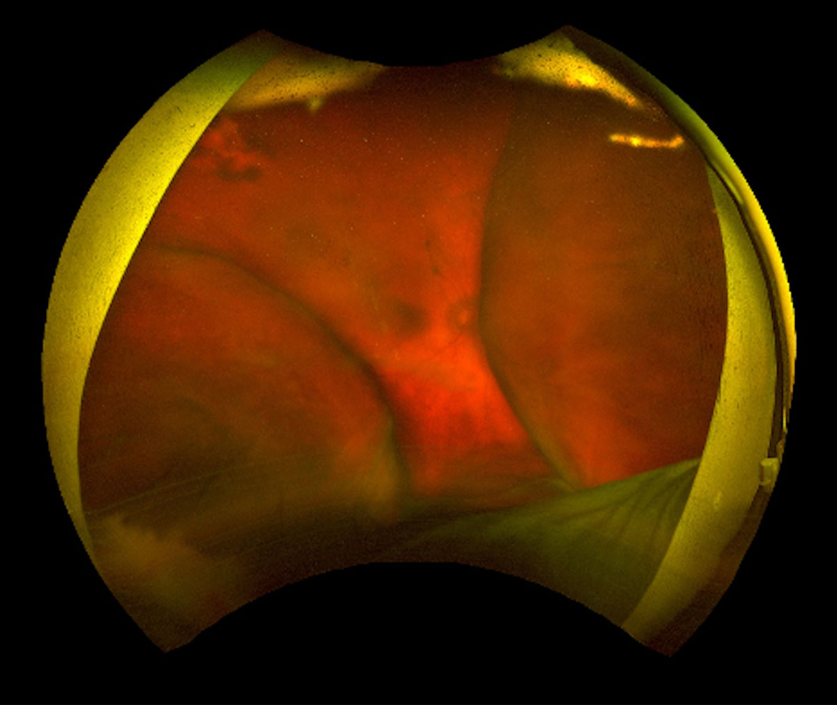 Figure 28.2 A
Spontaneous choroidal hemorrhage in a patient with thrombocytopenia secondary to Type 1 Chronic Myeloid Leukemia and lymphoplasmacytic lymphoma. The choroidals are non-appositional 