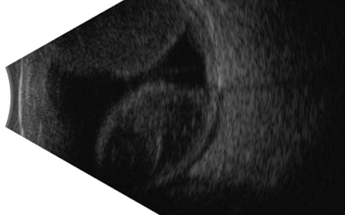 Figure 28.2 B
B-scan ultrasound showing the same. 