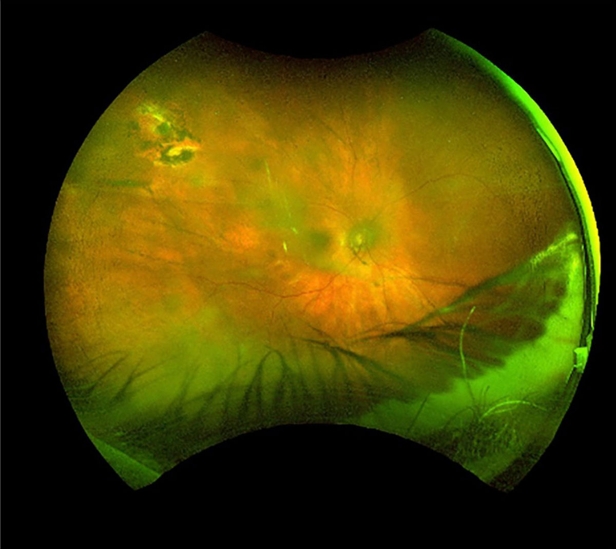 Figure 28.2 C
Complete resolution of the suprachoroidal hemorrhage after 6 weeks of medical management. The patient’s visual acuity returned to baseline without surgical intervention.