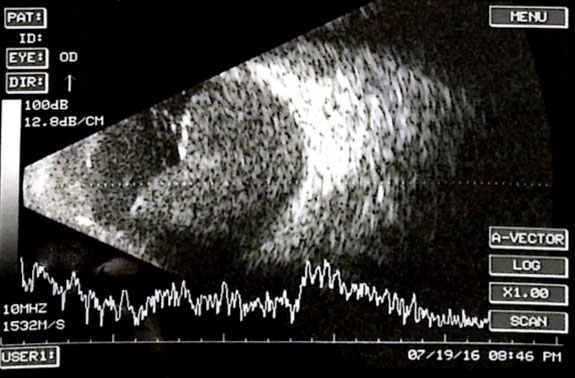 Figures 28.5 
B-scan ultrasound shows “kissing” hemorrhagic choroidals. The scan was performed prior to clot liquefaction. The A-scan shows low to medium reflectivity.