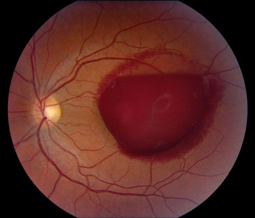 Figure 31.1 Sub-ILM Haemorrhage (Valsalva Retinopathy)